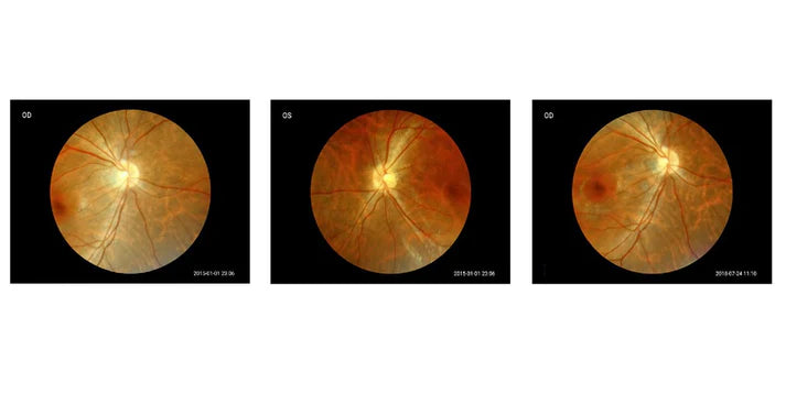INS-11107 | Hand-held Fundus Camera